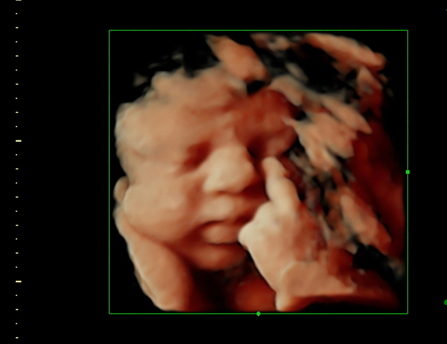 3D ultrasound image at 33 weeks